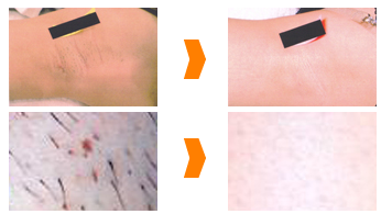 毛のサイクル～毛周期について