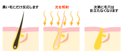 脱毛方法と脱毛期間